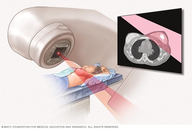 Blog Pic - Radiation therapy for BC.jpg